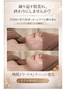 ビジュー(Bijou)/肌質改善!どんな肌質もOK!