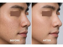 デジールの雰囲気(メンズ毛穴黒ずみテカリニキビケアに16500円→5980円)