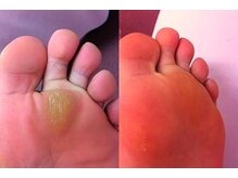 同心整体院/タコ、魚の目にお困りの方