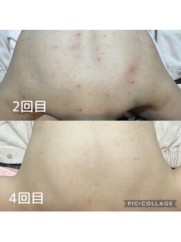 チャロアイト 可部店(Charoite)/背中周りケア