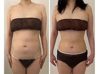 美人バスト大阪店/バストアップ ◇症例◇