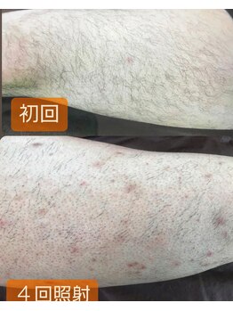 プロテア(Protea)/脱毛経過