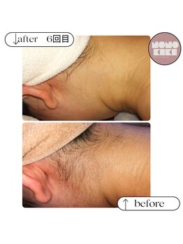 ノノケケ(NONOKEKE)/【レディース|脱毛】 うなじ脱毛