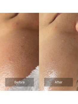 ハートランド(HEARTLAND)/毛穴が気になる夏にぴったり♪