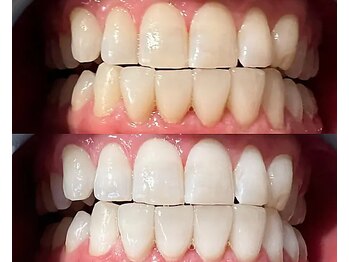 ライトケアサロン 表参道店(Light Care Salon)/セルフホワイトニング