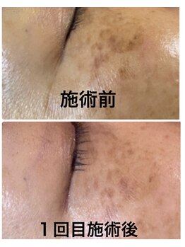 プリンセスモモ 佐世保白岳店(Princes Momo)/ビフォーアフター