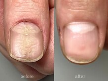 爪悩み専門店/凹凸爪