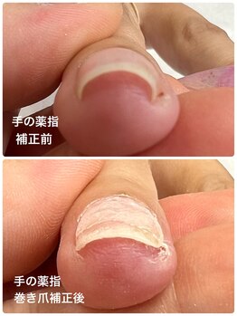 モスト(MOST)/手の巻き爪補正