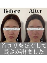 ハリサロンドオフ 心斎橋店(hari salon de off)/首肩凝りにも美容鍼を！