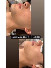 エルチェーロ(El Chulo)/LUMIX-A9X ヒゲ脱毛