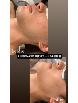 エルチェーロ(El Chulo)/LUMIX-A9X ヒゲ脱毛