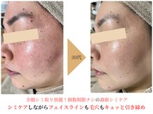 エソア(esoa)の雰囲気（驚異のシミケア！全顔5分で完了。毛穴、赤ら肌、シワ同時改善）