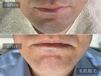 アムールサロン(Amour salon)/髭脱毛/ヒゲ脱毛/メンズ脱毛