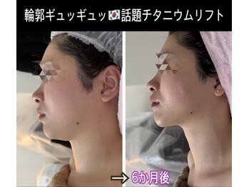 アルページュ(Arpege)の写真/韓国話題♪エステ版チタニウムリフト【小顔輪郭×高ハリ×色白シミケア×毛穴レス】一度で叶う欲張り美容