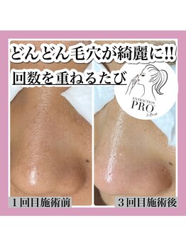 ブレスヘアー アイラッシュ(Breath hair eyelash)/最新毛穴エクストラクションプロ