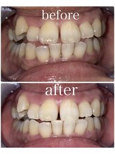 ホワイトニングビューティー 村上店(Whitening Beauty)/ナチュラルホワイトニング