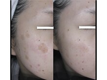 マイン 幸店/ドクターリセラADS美肌活性