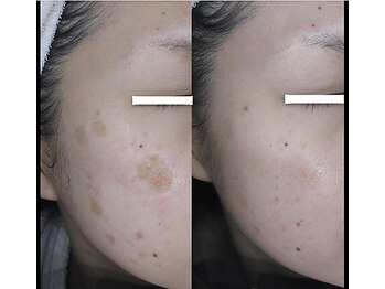 マイン 幸店/ドクターリセラADS美肌活性