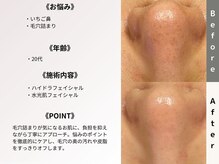 ルディラ 池袋店/ハイドラフェイシャル