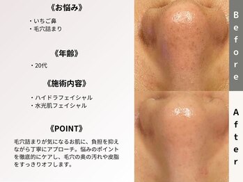 ルディラ 池袋店/ハイドラフェイシャル