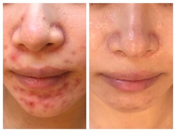 シュールサエラ 枚方店/艶を出す光フェイシャル