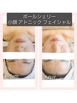 ヨリーズサロン(yoris.salon)/フェイスラインのたるみ改善◎