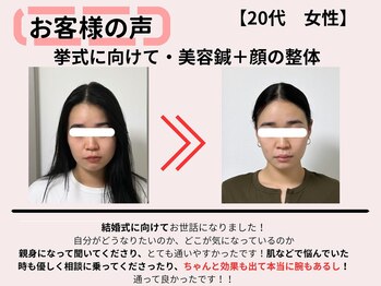 サロンスマイル/20代美容鍼ビフォーアフター