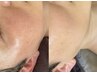  【日焼け後/赤み/敏感肌】〈トラブル救世主で潤いバリア〉レストセルTR