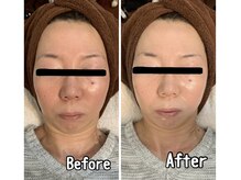 ブランシュール/ハイドラ×ヒト幹細胞導入