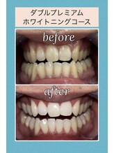 ホワイトニングビューティー 村上店(Whitening Beauty)/誰がみても白い歯