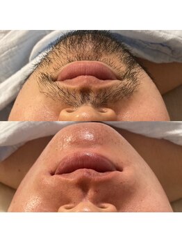 ララルアナ(Lara luana)/メンズ専用◎髭シュガー