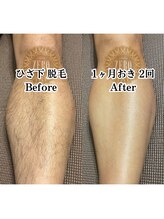 サロンゼロ 池上店(Salon ZERO)/膝下脱毛♪