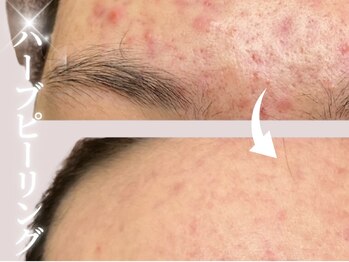 ジジベレッザ 芦屋店(jiji belleza)/剥けない贅沢ハーブピーリング