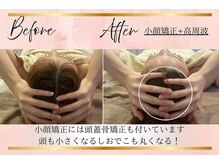 リーズリアン(Rises Lien)/【BeforeAfter】20代 リフトUP!
