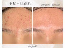 スリースリー(THREE THREE)/ニキビ・肌荒れケア