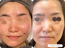 キュレイテッドスキン(CURATED SKIN)/ラミネーションピーリング