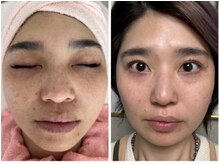 サロン ベベ(Salon Bebe)/最新シミケア！ホワイトラボ