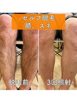 みつばちさろん/【セルフ脱毛】施術例「膝・脛」