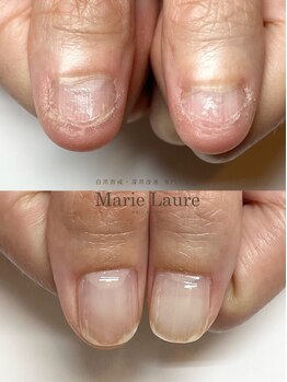 マリーロール 梅田店(Marie Laure)/自爪育成/深爪矯正/ネイルケア