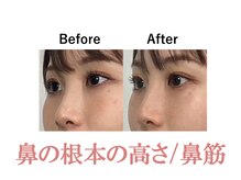 ラプリ 新宿店(Raplit)/隆鼻＋輪郭矯正40分10回