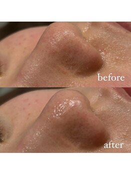 ユウユウ(YUYU)/毛穴洗浄