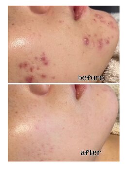 リリベル(LilyBell)/Before After