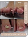 巻き爪ケア