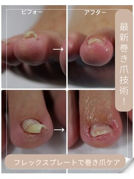 プリード 日進香久山店(PULIDO)/巻き爪ケア