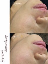 スマイルネイル(SMILE NAIL)/ハーブピーリング×毛穴洗浄