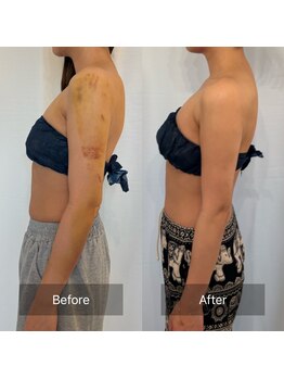 リセ(RESE)の写真/【術前・術後インディバ】術後のお悩みを最小限に、DTの辛さを緩和。