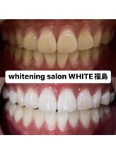 ホワイトニングサロン ホワイト(WHITE)/セルフホワイトニング☆効果