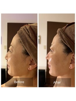 アムスパ(Aum Spa)/ヒト幹細胞上清液導入グロッティ