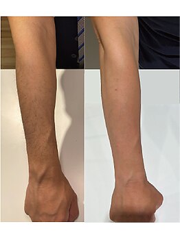 リリ(RiRi)/【脱毛】腕脱毛