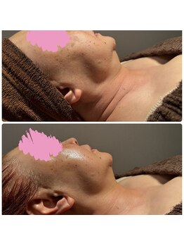 ルヴィショップ 沖縄(REVI SHOP)/リフトアップも叶う★